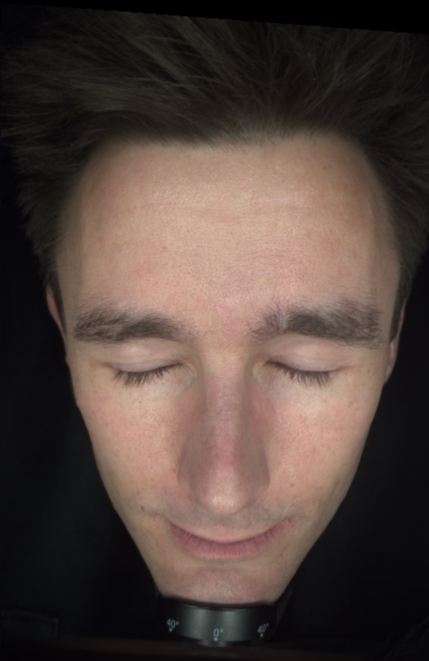 Before and after clinical skin analysis of a male patient showing improved skin tone and reduced redness after 6 weeks of SKIN FUEL™ - AFTER IMAGE