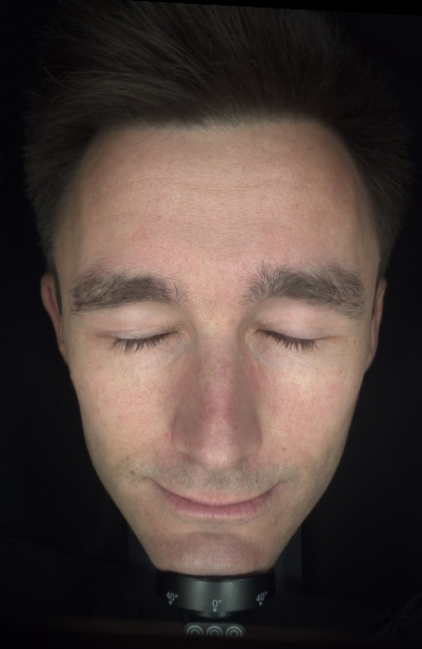 Before and after clinical skin analysis of a male patient showing improved skin tone and reduced redness after 6 weeks of SKIN FUEL™ - BEFORE IMAGE