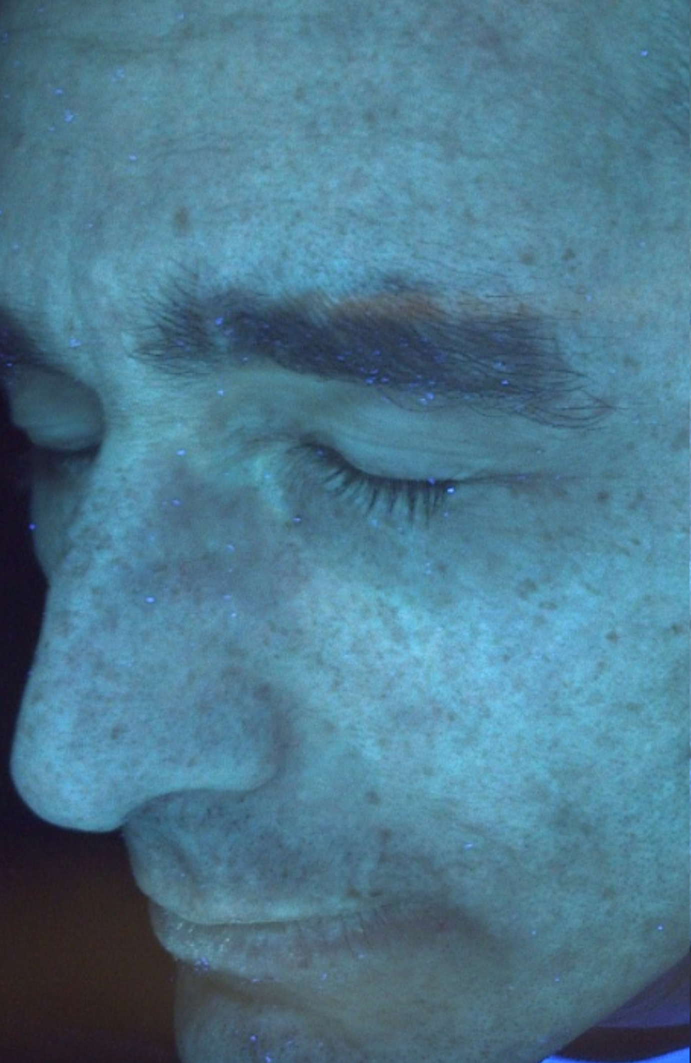 True UV skin analysis revealing improved deep-layer hydration and a strengthened skin barrier through consistent NAD+ and Hyaluronic Acid supplementation - AFTER IMAGE