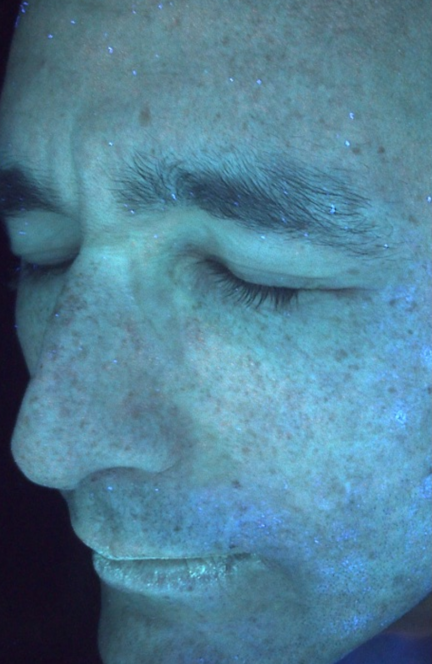 True UV skin analysis revealing improved deep-layer hydration and a strengthened skin barrier through consistent NAD+ and Hyaluronic Acid supplementation - BEFORE IMAGE