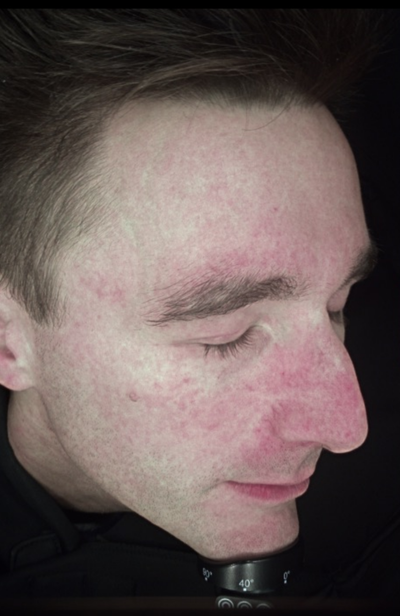 Observ 520x Cross-Polarized scan comparison demonstrating a significant reduction in vascular redness and inflammation on the cheeks and nose - BEFORE IMAGE