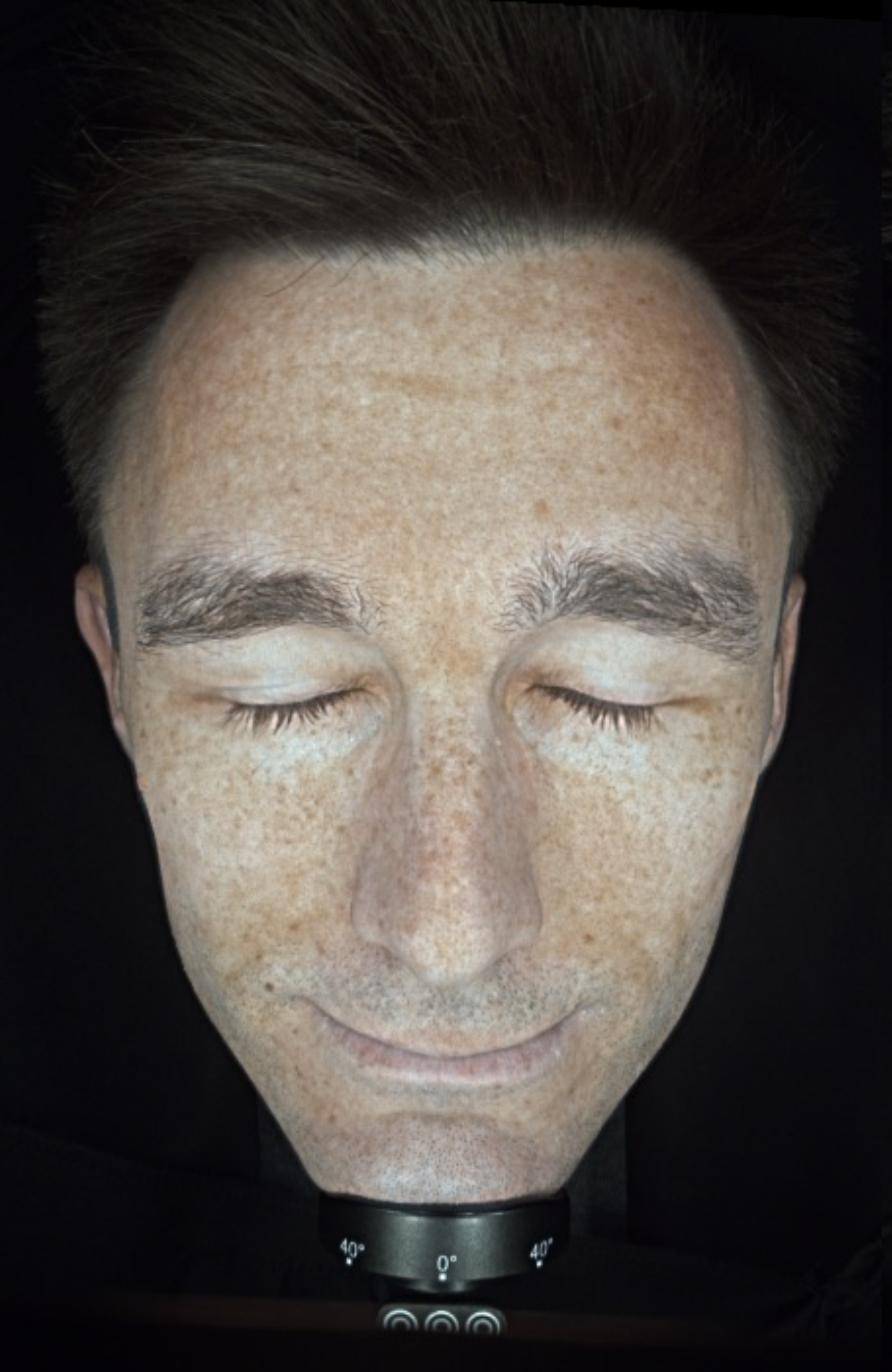 Clinical skin texture scan showing the softening of fine lines and a smoother, more resilient skin surface after 6 weeks of cellular nutrition - BEFORE IMAGE