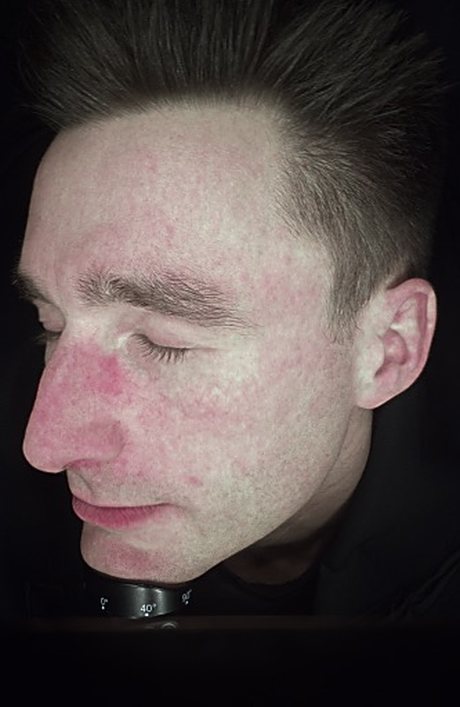 case-redness-after12