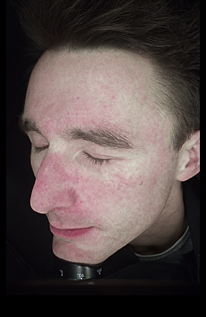 case-redness-before